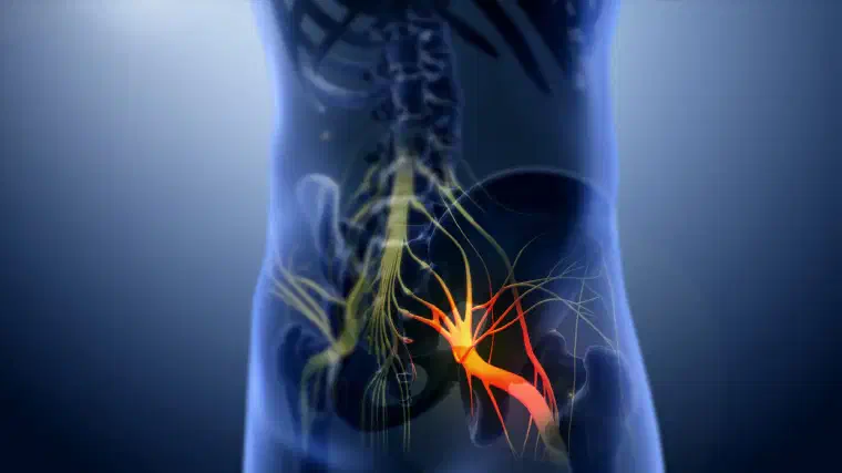Medical visualization representing sciatica, hip pain, and nerve-related symptoms